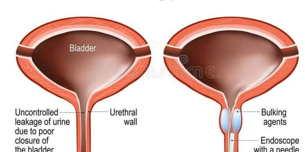 Understanding Urinary Incontinence: Causes, Types, and Treatment Options